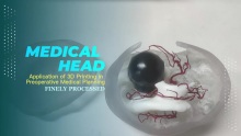 Application of 3D printing in preoperative medical planning